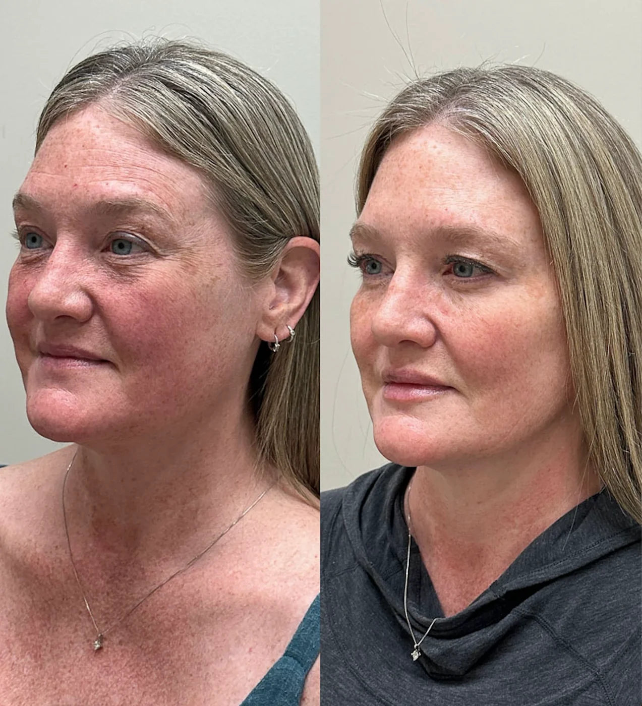 Before and after photo, Before / After